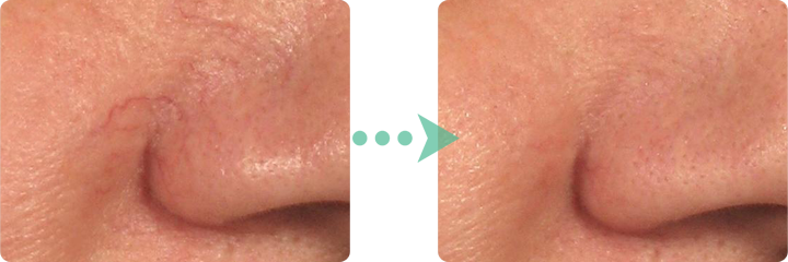 毛細血管：鼻の周りの毛細血管が薄く。